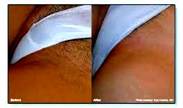Bikini line laser hair removal obtain a perfect bikini line double-dipping, states Shobha Tummala